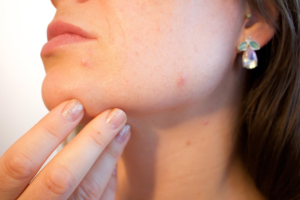 skincare for acne – close-up of acne-prone skin
