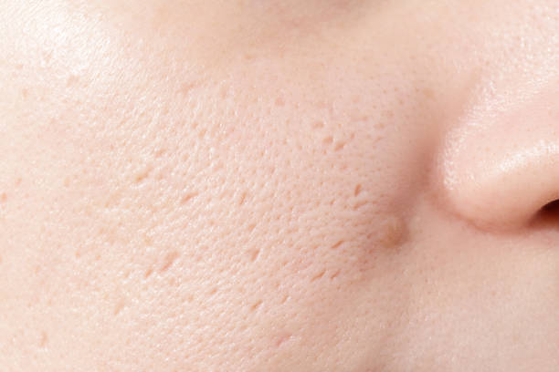 acne scar removal treatments