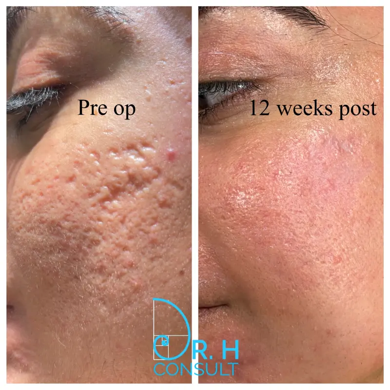 Woman gently exfoliating her face to show the benefits of exfoliation for glowing skin.