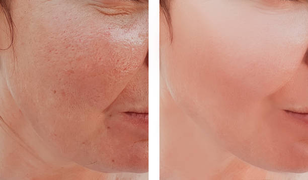 skincare for acne – close-up of acne-prone skin